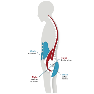 lower-muscle-imbalance