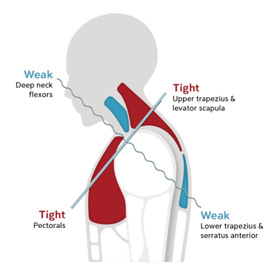 upper-muscle-imbalance